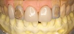 黄色い歯を白くする（銀座アレーズ/銀座の歯科医院）審美歯科治療例