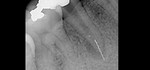 ユーズ大阪歯科医院 根管治療 症例5 治療用器具破折の除去ケース 